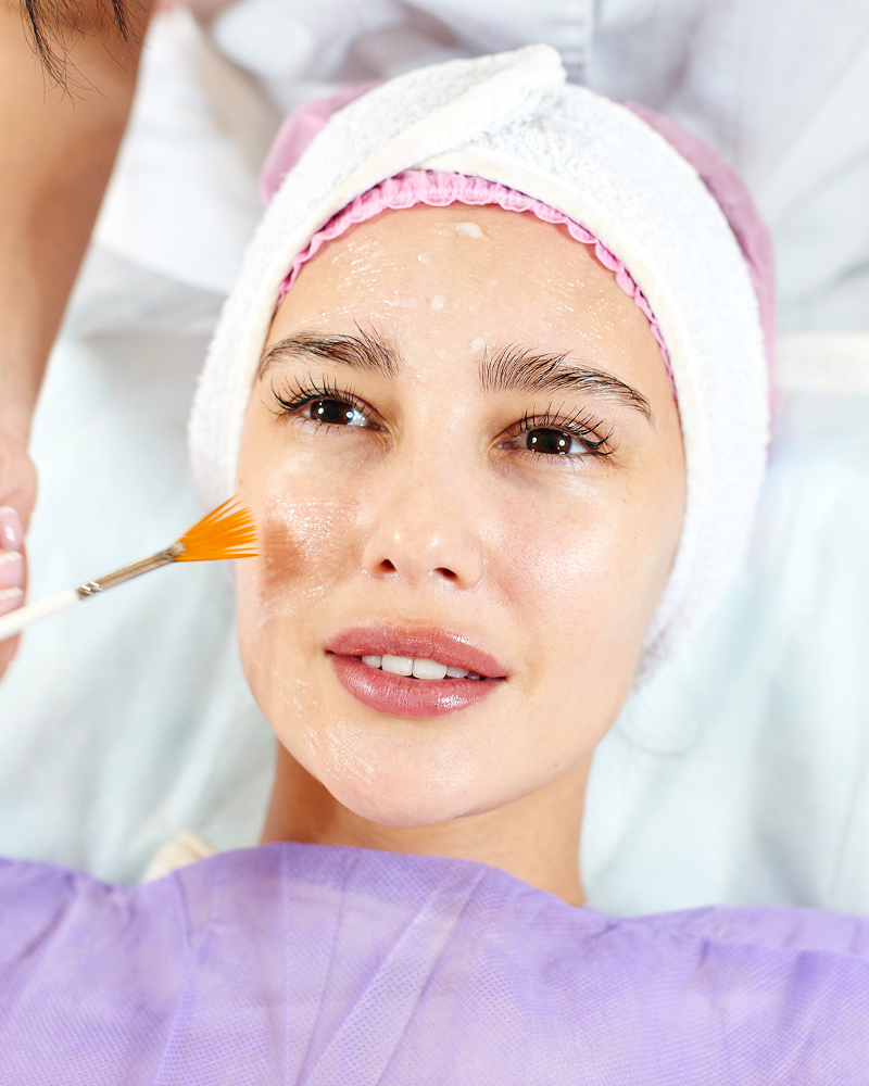 Active Acne Acne Scarring Facial Chemical Peel